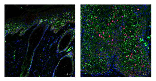 Aberrant expression of the transcription factor SOX2 (red) in mouse cutaneous squamous cell carcinoma (cSCC). Left: hyperplastic mouse skin adjacent to SCC. Right: SCC induced by chemical carcinogenesis. Nuclei are stained with DAPI (blue), and E-cadherin is stained in green -ft CREDITS@CEINGE