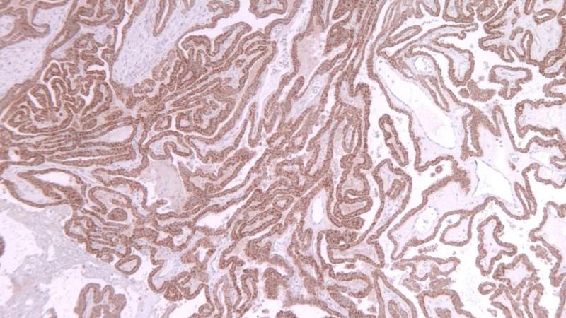 carcinoma tiroideo avanzato